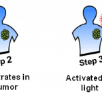 光動力療法(PDT)