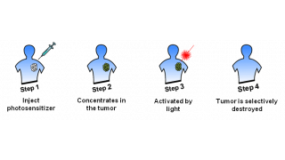 光動力療法(PDT)